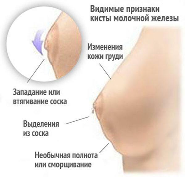 Visible signs of the breast