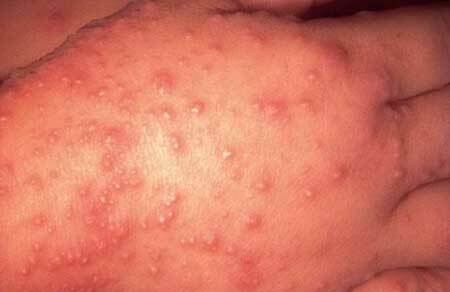 Symptoms of the Coxsackie virus