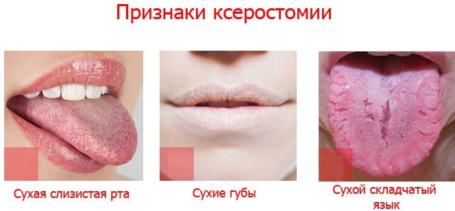 Viscous saliva in the mouth. Causes, treatment with folk remedies in a child, pregnant women, adults