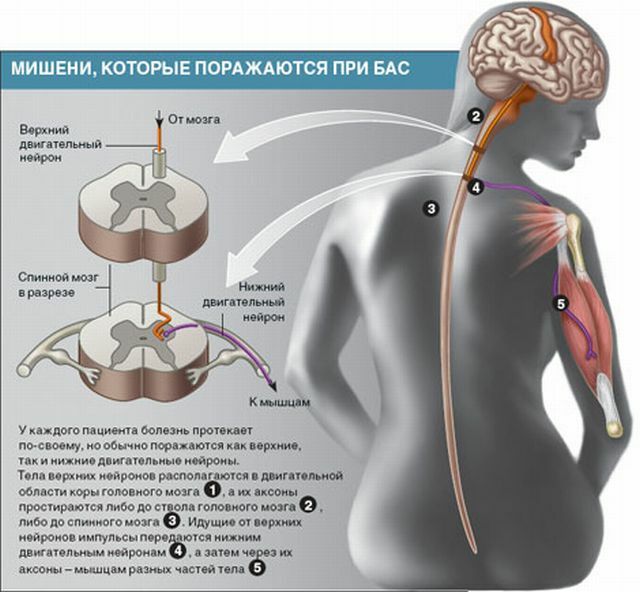Motor nöronun hastalığı: ALS'nin ve diğer MND formlarının semptom, teşhis ve tedavisi