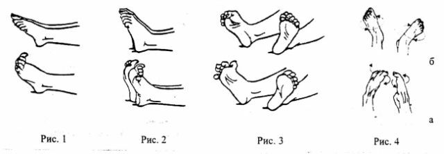 Çekiç şeklinde ayak parmaklarını zamanında algılama ve tedavi etme