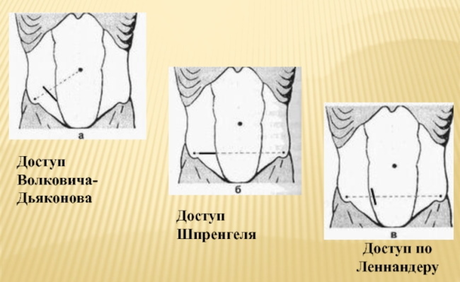 Appendectomy according to Volkovich-Dyakonov by pararectal incision according to Lenander. Appendectomy