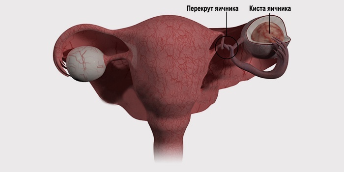 Allocations in the ovarian cyst