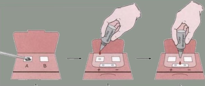 Occult blood in the stool is positive. What does this mean in an adult, a child, causes, treatment