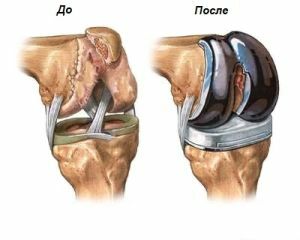 joelho protético