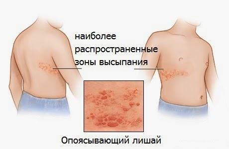 Najpogostejši kraji lokalizacije herpes zoster