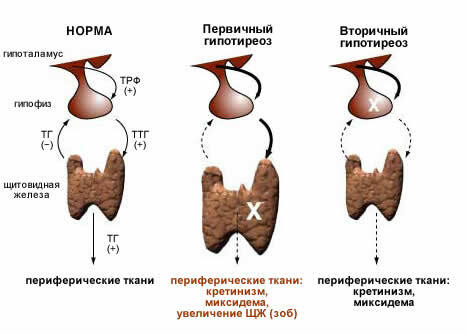 Hypotyreóza u mužov