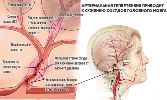 Aterosklerose i nakkens, hovedets kar. Symptomer og behandling