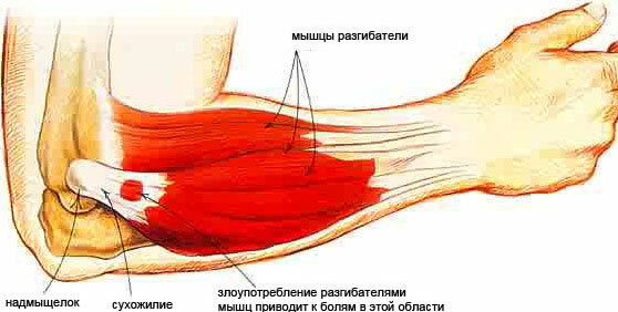 Epicondilite dell'articolazione del gomito - trattamento, sintomi, cause, esercizi, foto