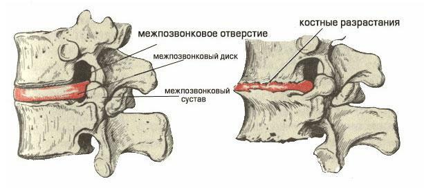 Scheme of osteochondrosis