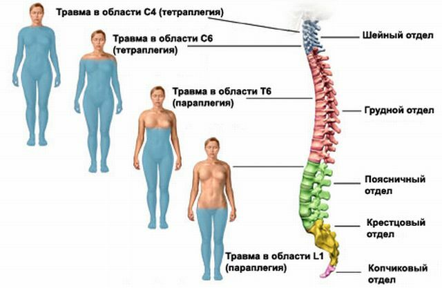 Areas of spinal cord injury