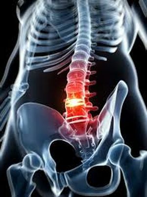 smerte syndrom i rygsøjlen