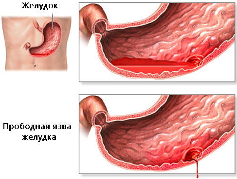 Ostry brzuch w chirurgii. Objawy choroby, wytyczne kliniczne