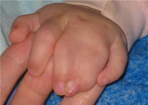 Syndactyly of the toes and the hand in children