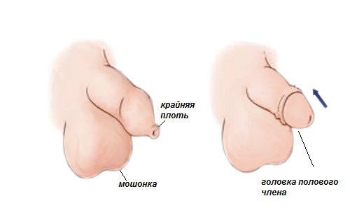 How dangerous is the fusion of the foreskin with the head of the penis and whether it is necessary to treat it