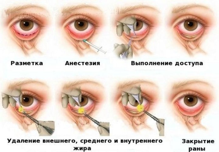 Hernia of the lower eyelid. Photo, how to remove without surgery, treatment