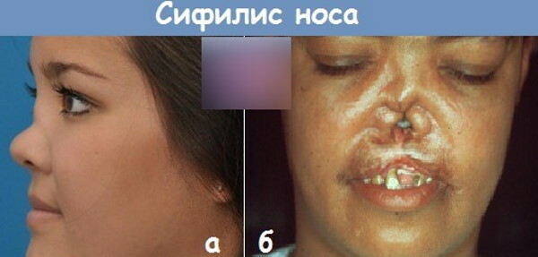 Syfilis i ansiktet. Foto på utslag, hur det ser ut
