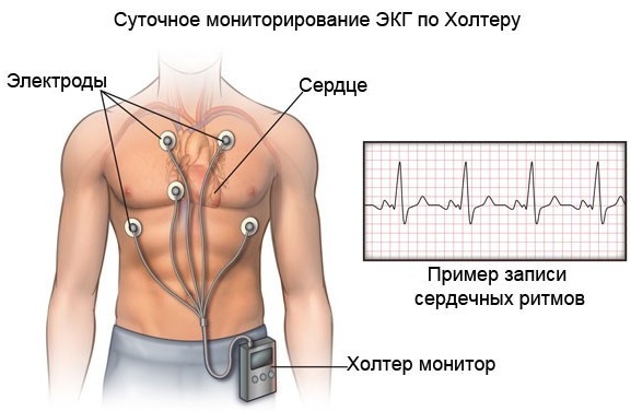 Ventrikulær ekstrasystol på EKG: tegn, dekoding