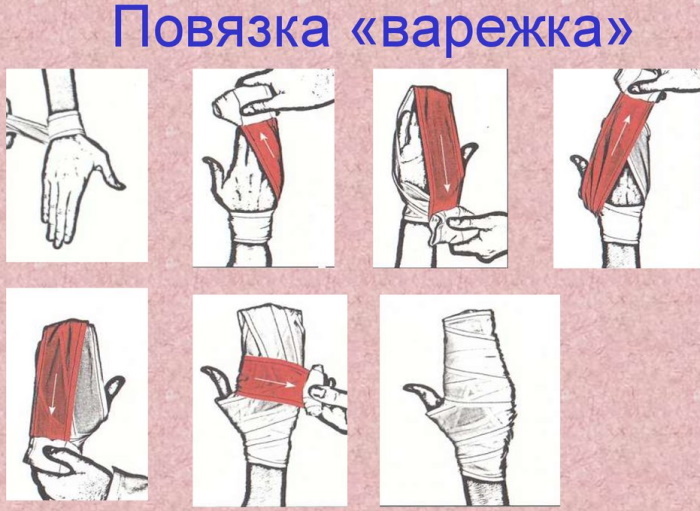 Bandage a mitten on a wrist. Algorithm, overlay technique, readings