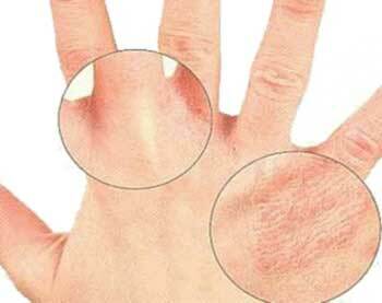 first signs of scabies photos