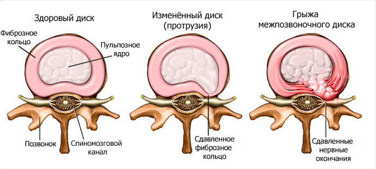 Formação de um disco intervertebral herniado