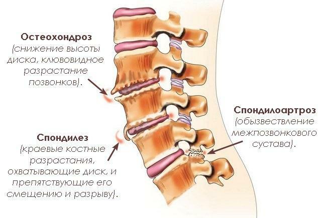 Espondilosis de la columna vertebral