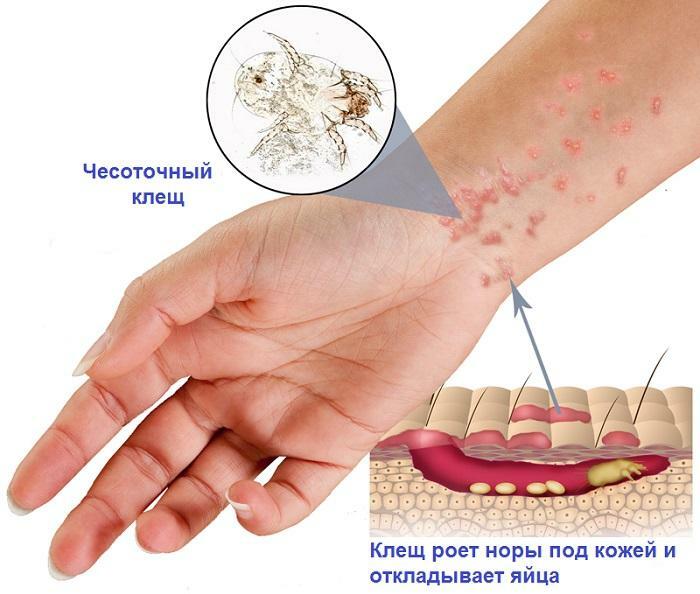 How to treat scabies in the home