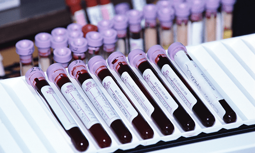 Análise de sangue para patologia cromossômica