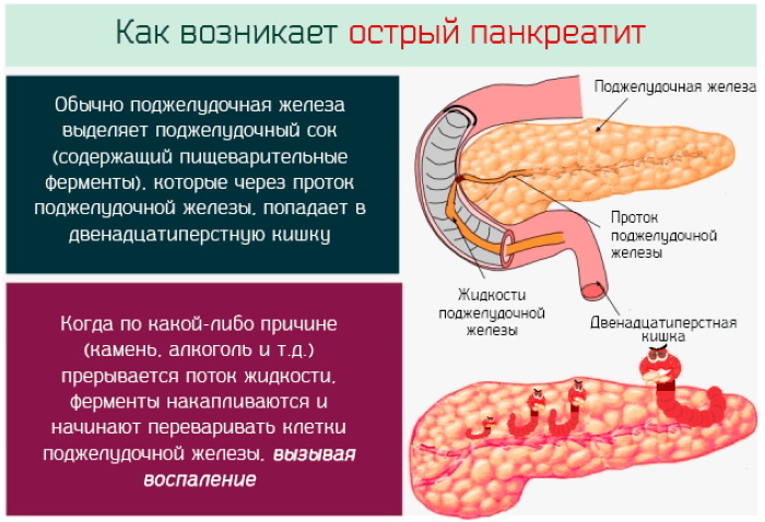 Symptomer på pancreas pancreatitis hos kvinder, mænd