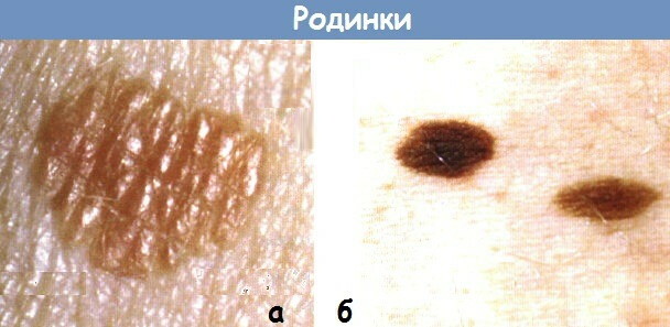 Tipi di nei sul corpo, sul viso. Foto con una descrizione, pericolose o no