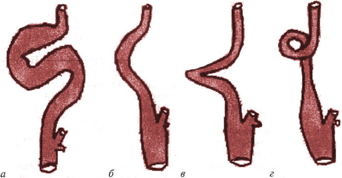 Espiral de la arteria carótida interna. Peligro lo que es