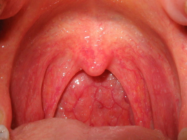 Red throat does not go away for a week, 2 weeks. What to do
