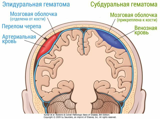 Subduralhämatom des Gehirns: Behandlung und Folgen