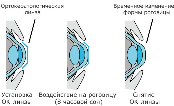 Zhdanovs teknikk for å gjenopprette synet. Øvelser