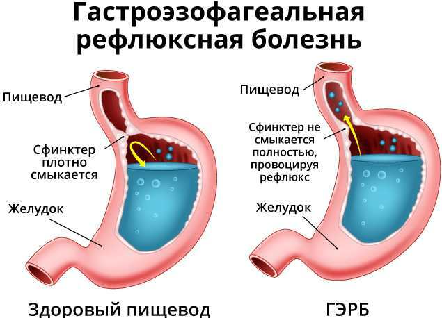 Malattia da reflusso gastroesofageo. Sintomi e trattamento