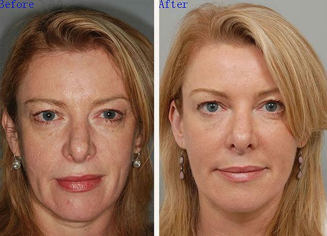Before and after thermolift