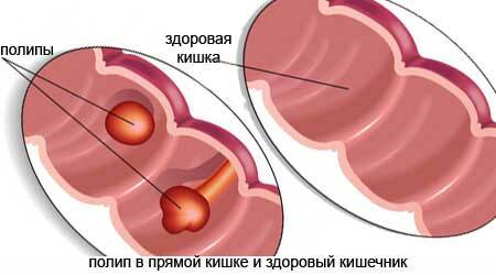 Symptomen van poliepen van het rectum