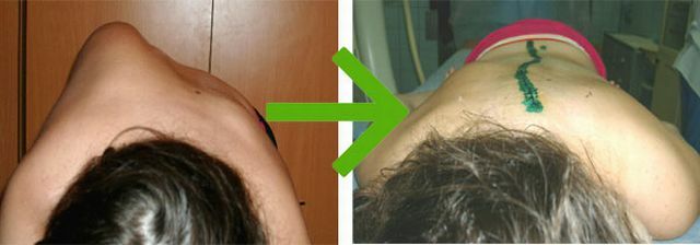 prije i poslije operacije za skoliozu