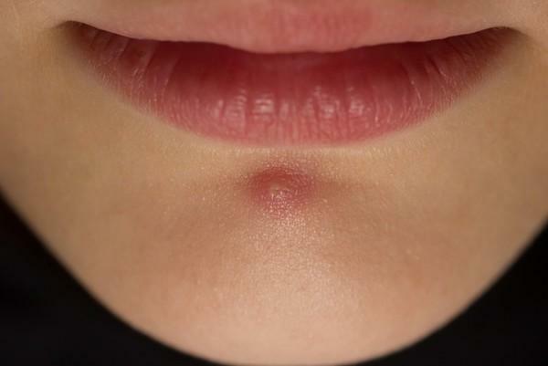 Pimples na bradi žena: razlog