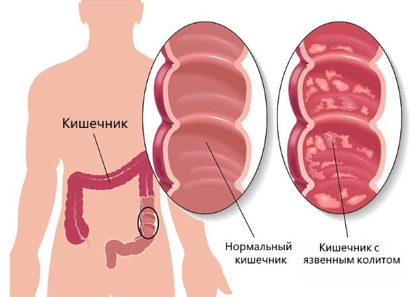 The human gastrointestinal tract (GIT). Anatomy, structure, diseases, symptoms, treatment