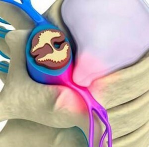 Myelopathie: de oorzaak en het gevaar van beschadiging van het ruggenmerg
