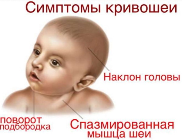 Tortikolis u dojenčadi 2-3-4-6 mjeseci. Simptomi, fotografije, liječenje