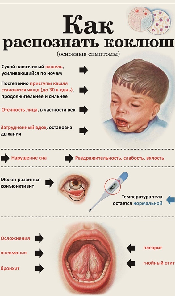 La tos ferina. Los síntomas y tratamiento de adultos infecciosa, el período de incubación