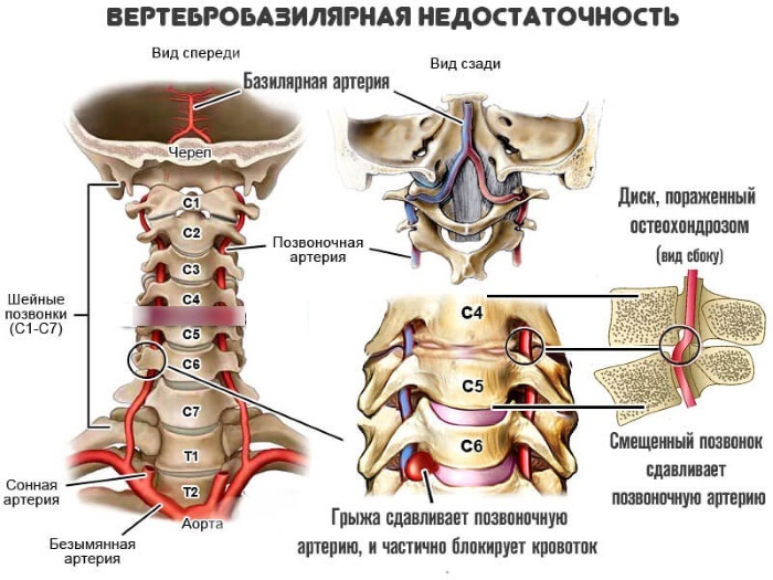 Diagnóza VBN v neurológii. Čo je vertebrobasilárna nedostatočnosť, liečba