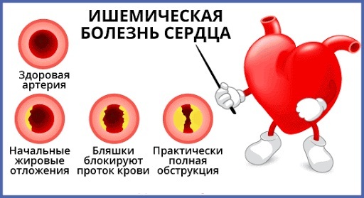 Ischemická choroba srdca. Príznaky a liečba, lieky, ľudové prostriedky