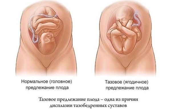 Hip dysplasia in the newborn. Symptoms, signs, treatment