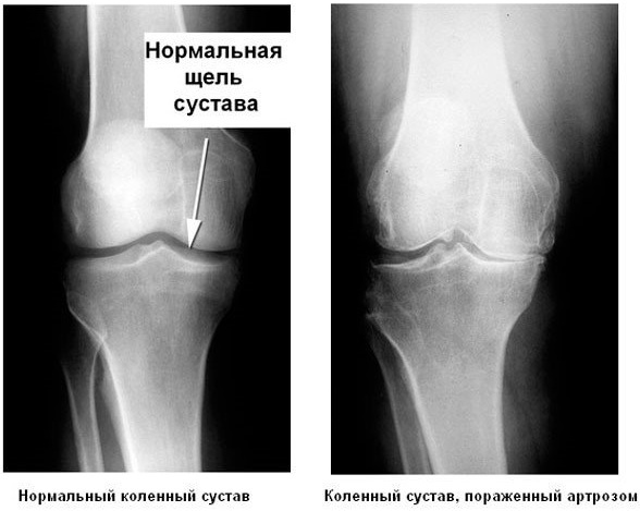 Røntgen af ​​knæleddet i to fremspring. Pris, som viser hvordan det er gjort