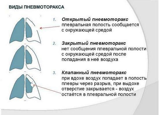 A pneumothorax típusai