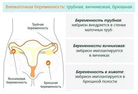 Ektopiás terhesség