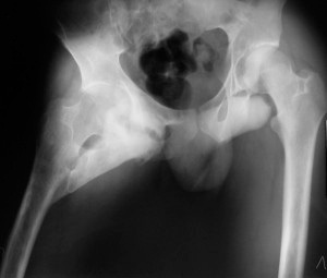 ossicles of the hip joint